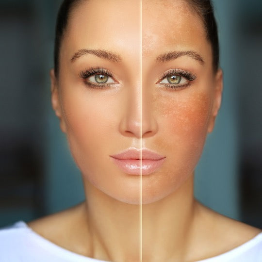 Understanding and Treating Melasma and Hyperpigmentation: Your Path to Radiant Skin