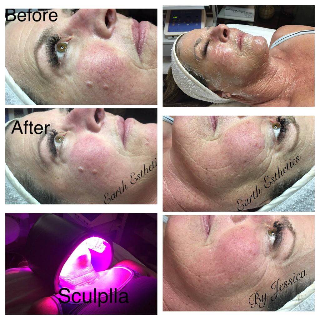 Sculplla,  Korean  filler treatment